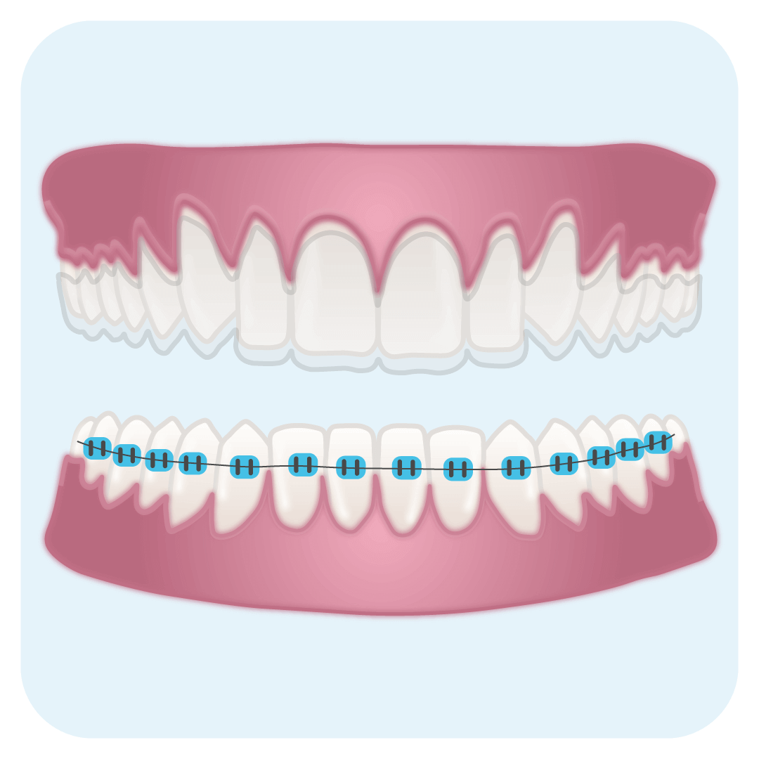 alternative-to-braces-and-aligners-icon.png