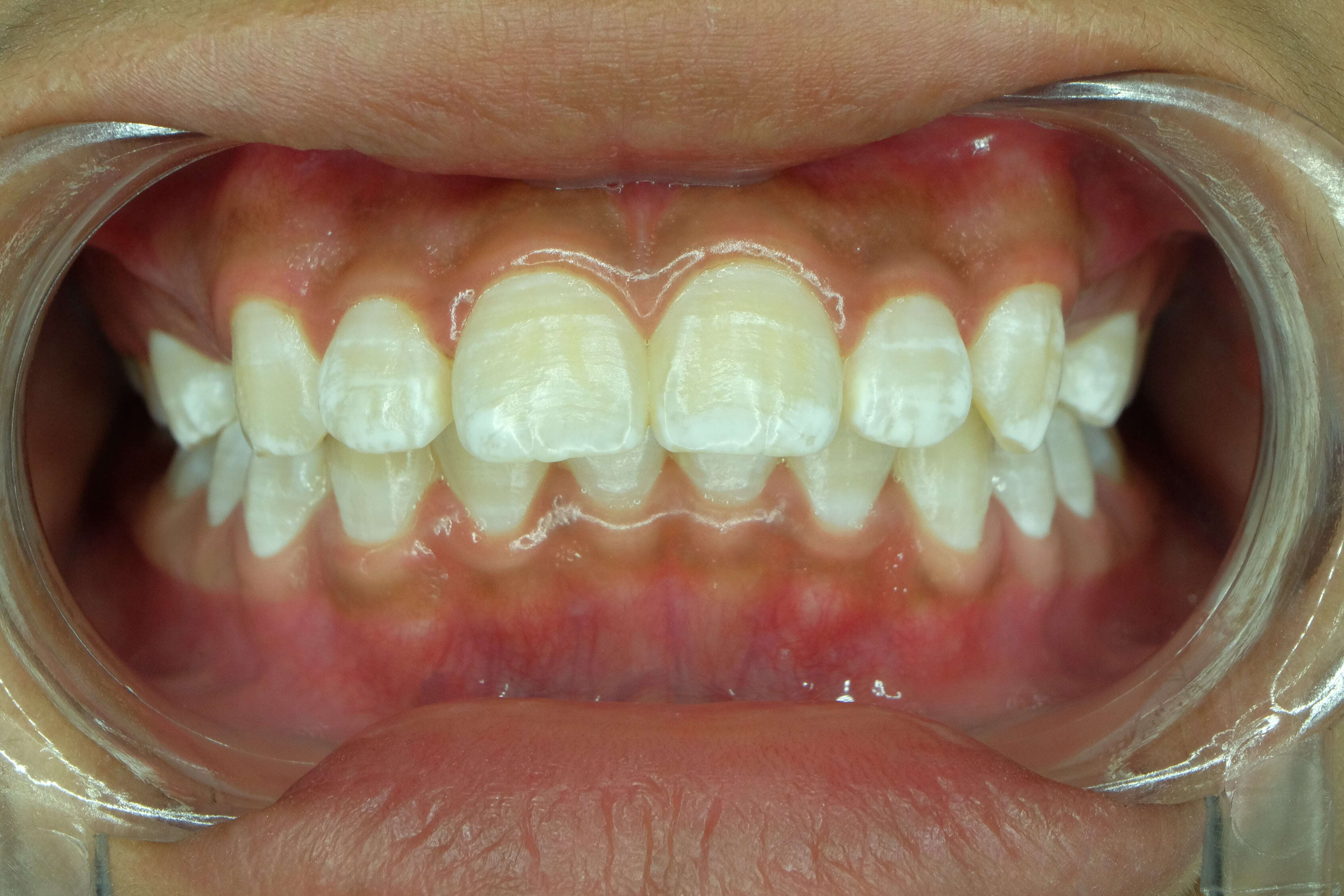 Veneers for dental fluorosis - instasmile