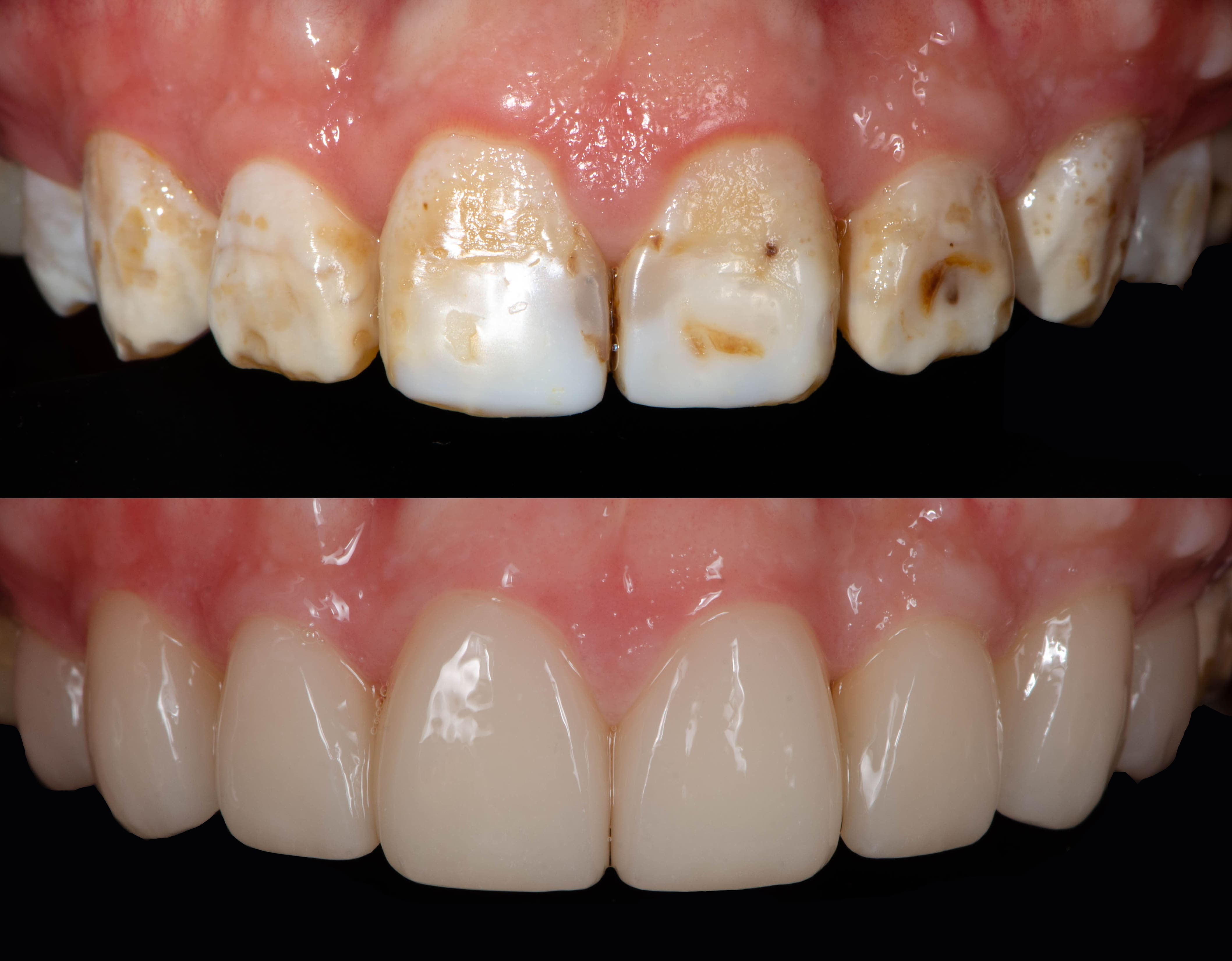 Clip-on veneers for dental fluorosis- instasmile