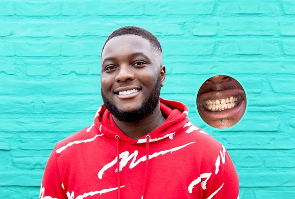 Non surgical dental implants - instasmile