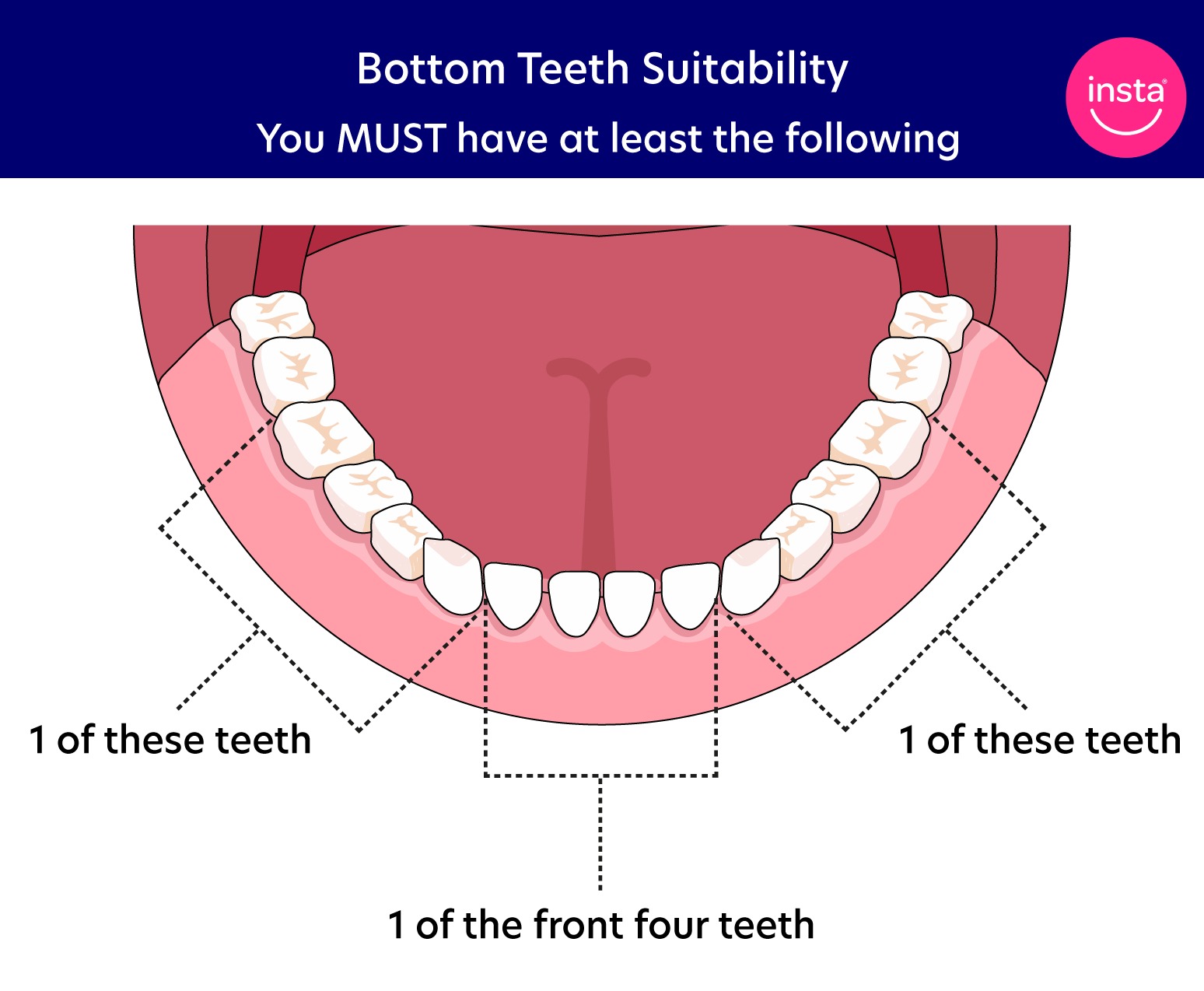 Can you get clip-on veneers if you have missing back teeth? - instasmile