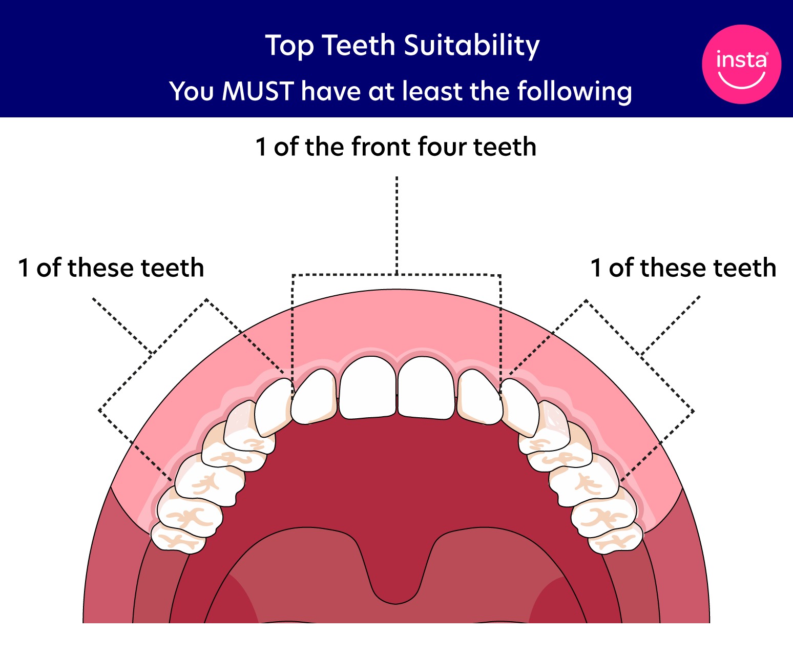 Can you get clip-on veneers if you have missing back teeth? - instasmile